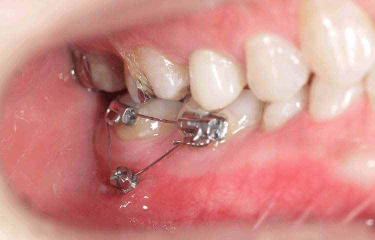 ミニインプラント矯正