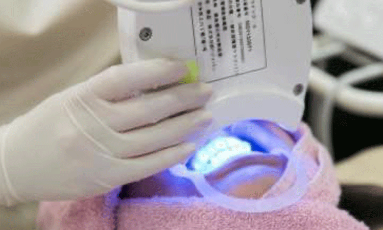 ホワイトニング