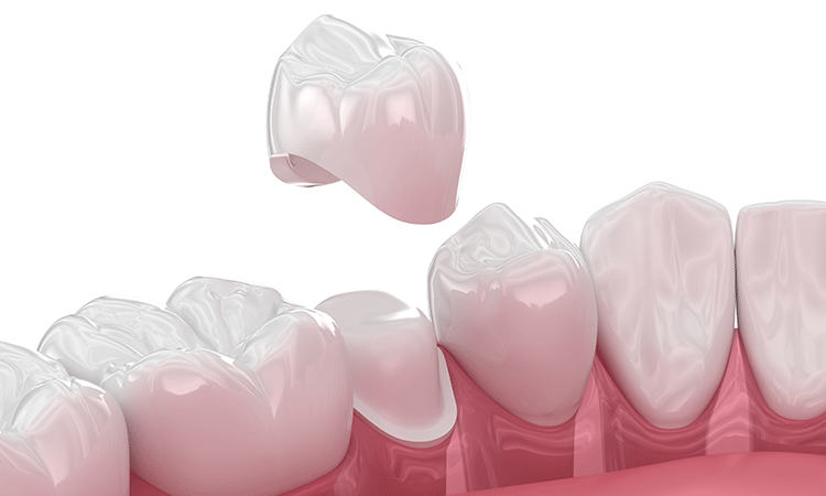 詰め物・被せ物の審美修復