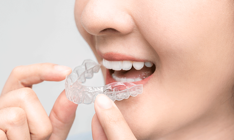 歯並びを美しく整える治療