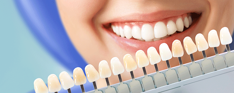 セラミック治療が選ばれている理由