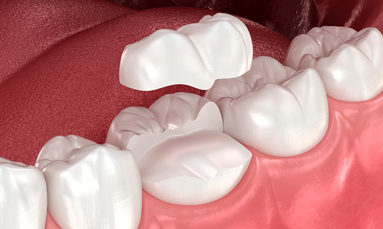 セラミックインレー