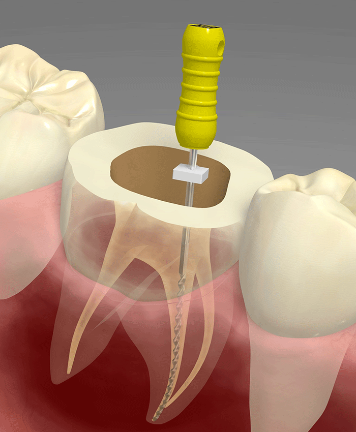重度の虫歯には〔根管治療〕を