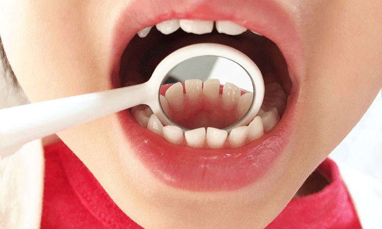 乳歯は永久歯に比べて虫歯になりやすい！