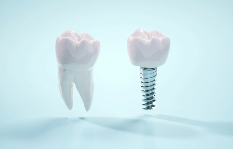 インプラント治療