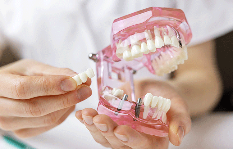 インプラント手術の全てを分かりやすく説明