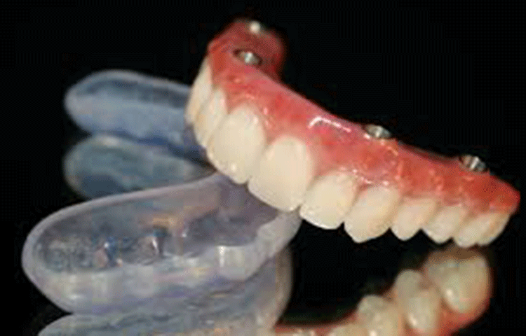 サージカルガイドの使用