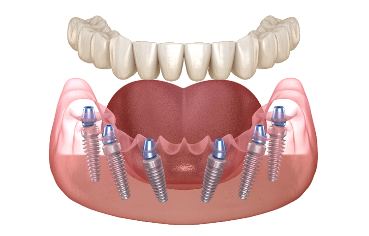 インプラント一次手術
