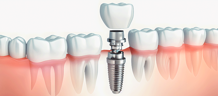 インプラントとは