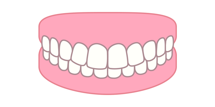 出っ歯（上顎前突）