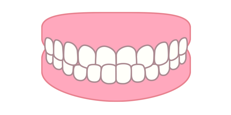 出っ歯（上顎前突）