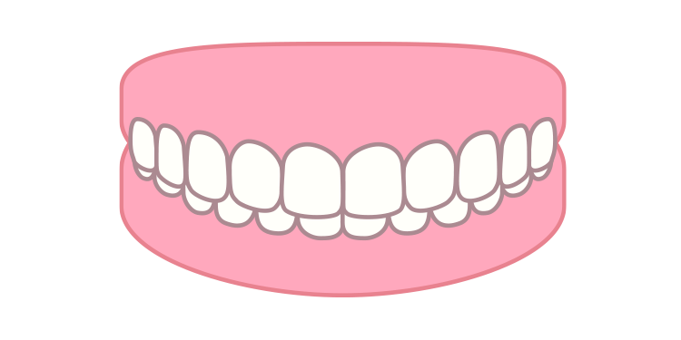 過蓋咬合（かがいこうごう）