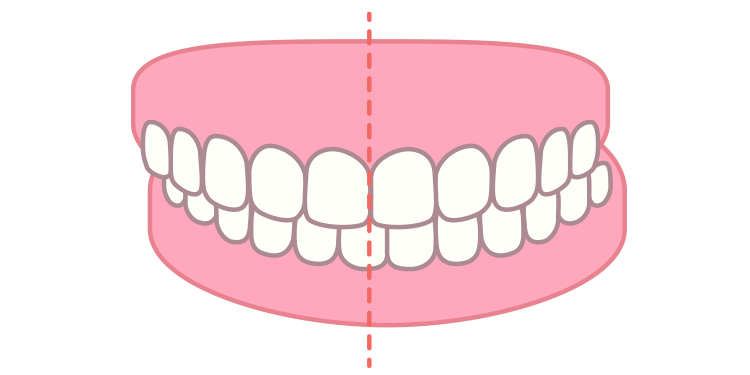 交叉咬合（こうさこうごう）
