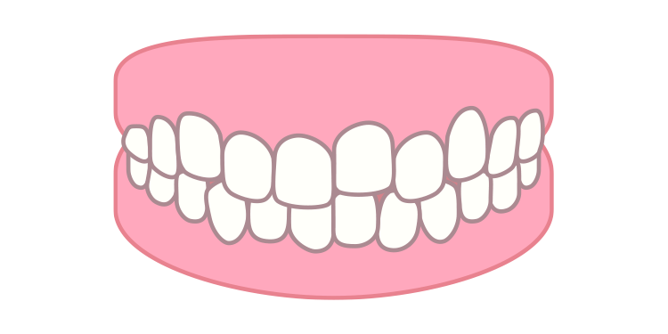 叢生（そうせい・乱ぐい歯）