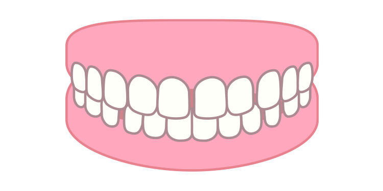 空隙歯列（すきっ歯）