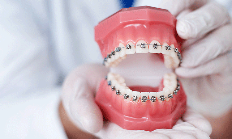 ワイヤー矯正でしっかりとしたかみ合わせと美しい歯並び