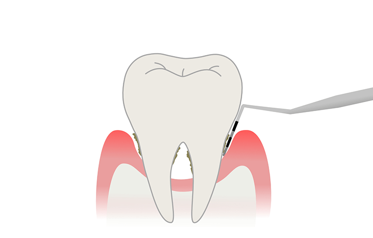 歯周ポケットの深さと歯周病の目安