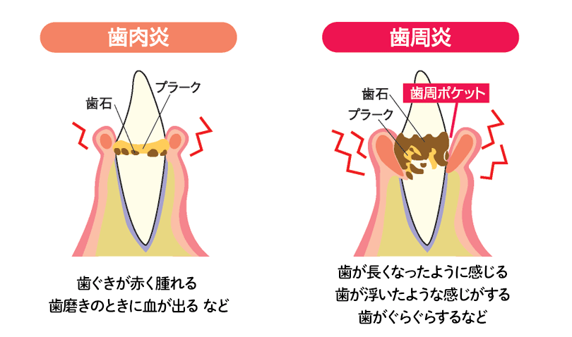 歯周炎と歯周病の違い