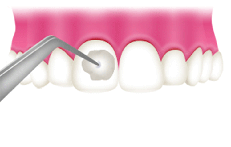 歯石除去・クリーニング